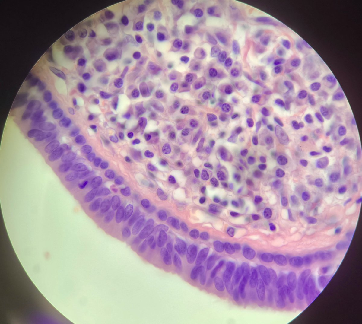 DjamalMestar's tweet photo. Cystic invaginations, double-layered epithelium with decapitation secretion, and a dense plasma cell infiltrate.

​Diagnosis: Syringocystadenoma Papilliferum (SCAP)

​#Anapath #Pathology #DermPath #SkinPath #MedX #Histology #Plasmocytes #SCAP https://t.co/2Kb9HI1pas
