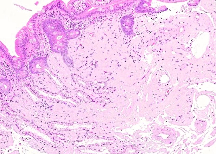 katcollmd's tweet photo. #GISlideBar who said amyloid is only pink? 🤔 #gipath #pathtwitter #pathoutpic 

🍏 Congo red gives apple-green birefringence
💙 Trichrome paints it pale blue (not brilliant blue like collagen)

🔗 https://t.co/UXccA8FRgi https://t.co/WKWcneWKsT