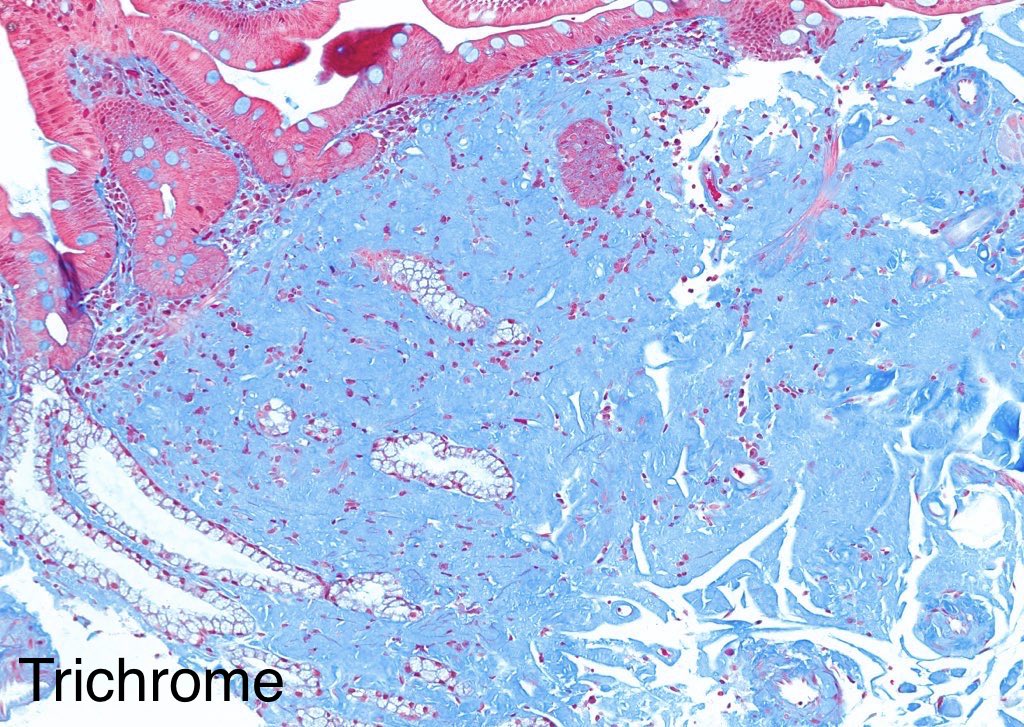 katcollmd's tweet photo. #GISlideBar who said amyloid is only pink? 🤔 #gipath #pathtwitter #pathoutpic 

🍏 Congo red gives apple-green birefringence
💙 Trichrome paints it pale blue (not brilliant blue like collagen)

🔗 https://t.co/UXccA8FRgi https://t.co/WKWcneWKsT