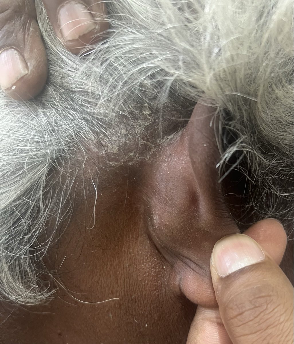 IlliasulK's tweet image. This patient presented with pain at Achilles insertion ….

What is the most likely  diagnosis?

#MedTwitter #RheumTwitter #Medicine #rheumatology @docakx @IhabFathiSulima @CelestinoGutirr