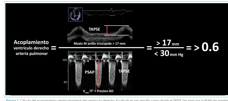 LeslieMegom's tweet photo. 🔰Acoplamiento ventrículo–arterial derecho (VD–AP) parámetro clave en la evaluación de la función del ventrículo derecho🫀
☕️Notas cafeteras. 
“RV protective” (protección del ventrículo derecho) es una estrategia de manejo ventilatorio y hemodinámico diseñada para:
↪️ Evitar el desacoplamiento VD–arteria pulmonar y prevenir falla del ventrículo derecho.
☝🏻🤓En patologías como el SDRA:
▪︎La ventilación mecánica
▪︎La hipoxemia
▪︎La hipercapnia
👉 ⬆️Aumentan la resistencia vascular pulmonar (poscarga del VD)
➡️ Esto puede llevar a:
Dilatación del VD
↓ gasto cardíaco
↓ DO₂ sistémico
Shock
📌 Por eso nace el concepto:
🧠 No solo proteger el pulmón (lung protective)… sino también proteger el VD (RV protective)‼️
🎯 El acoplamiento ventrículo-arterial derecho representa un cambio de paradigma:
●  Pasamos de evaluar “función del VD” → a evaluar su eficiencia energética frente a la carga pulmonar
👉 Es un parámetro: Fisiológico, integrador, pronóstico, accionable en UCI.
📌El acoplamiento ventrículo-arterial derecho (VD–AP) describe la relación entre la contractilidad del ventrículo derecho (VD) y la poscarga impuesta por la circulación pulmonar. Es un concepto derivado de la fisiología presión-volumen, donde:
▪️Ees (elastancia ventricular) = contractilidad del VD🫀
▪️Ea (elastancia arterial pulmonar) = carga vascular pulmonar🫁
👉 El cociente Ees/Ea define el grado de acoplamiento.💥
📌 Fisiología clave
🫀Un VD óptimamente acoplado transfiere energía eficientemente a la arteria pulmonar.
📚El valor ideal de acoplamiento:
🔰Ees/Ea ≈ 1.5–2 → eficiencia máxima🤗
🔰Ees/Ea < 0.8 → desacoplamiento (fallo del VD)😵‍💫
🫁 Importancia en el paciente crítico
🫀El VD es altamente sensible a cambios en la poscarga. En escenarios como:
▪️SDRA
▪️Tromboembolia pulmonar
▪️Hipertensión pulmonar
▪️Ventilación mecánica (↑ presión intratorácica)
▪️Sepsis con disfunción miocárdica
👉 El desacoplamiento VD–AP es un marcador temprano de fracaso hemodinámico antes de la caída del gasto cardíaco.🫀
⚖️Métodos de evaluación
1️⃣. Método gold standard (invasivo)
Bucles presión-volumen del VD
Medición directa de Ees/Ea
2️⃣. Métodos no invasivos (ecocardiografía crítica)
🔹 TAPSE/PASP
▪️TAPSE = excursión sistólica del anillo tricuspídeo
▪️PASP = presión sistólica pulmonar
👉 TAPSE/PASP ≈ surrogate de Ees/Ea.
TAPSE/PASP es un “surrogate” de Ees/Ea
➡️ Porque no mide directamente el acoplamiento, pero se correlaciona bien con él.
▪️> 0.31 mm/mmHg → buen acoplamiento
▪️< 0.31 → desacoplamiento VD–AP
🔹 S’/PASP (Doppler tisular)
💥Alternativa más sensible en algunos escenarios.
🔹 RV free wall strain / PASP
🫀Más precoz para detectar disfunción subclínica
🫀El acoplamiento VD–AP no debe verse aislado, sino como parte de la coherencia hemodinámica global:
▪️VD desacoplado → ↓ flujo pulmonar → ↓ retorno al VI
▪️↓ DO₂ sistémico → hipoperfusión tisular
▪️↑ presión venosa → congestión sistémica (VExUS positivo)
📍 1. SDRA
●PEEP alta → ↑ Ea → riesgo de desacoplamiento
●TAPSE/PASP permite ajustar ventilación “RV protective”
📍 2. Tromboembolia pulmonar
●Aumento súbito de Ea
●Desacoplamiento predice mortalidad
📍 3. Sepsis
●Miocardiopatía séptica → ↓ Ees
●Evaluar acoplamiento evita sobrecarga hídrica.
📍 4. Ventilación mecánica
●Driving pressure alta → impacto en VD
●Integrar con mecánica respiratoria
💎 PERLAS CAFETERAS ☕️
📣¿Qué implica una estrategia RV protective?
🎯Es un enfoque que modifica la ventilación para no dañar el VD
🔰Objetivos principales:
1. Reducir la poscarga del VD
⚠️Evitar:
▶️Hipoxemia
▶️Hipercapnia
▶️Acidosis. ....aumentan la resistencia pulmonar ‼️
2. Limitar presiones ventilatorias:
▶️Plateau pressure < 26–27 cmH₂O
▶️Driving pressure < 15 cmH₂O 
👉 Altas presiones → ↑ presión pulmonar → sobrecarga del VD
3. Ajuste cuidadoso de PEEP
Evitar:
▶️Atelectasia (↑ poscarga)
Sobredistensión (↑ poscarga)
👉 El problema no es solo la PEEP…cont.