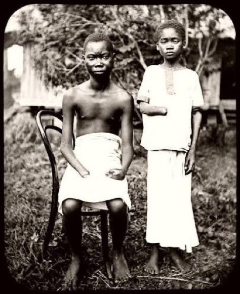 GUnderground_TV's tweet photo. On this day in 1835, one of Europe’s worst monsters, King Leopold II of Belgium🇧🇪, was born. 

During his rule, he declared Congo as his personal colonial possession and proceeded to commit horrific genocide upon the Congolese people. 

8-10 million Congolese died during ‘personal rule’, with violence as a mechanism of organising production. Through mercenaries, prisons, forced starvation, and executions, Leopold II turned Congo into a concentration camp, using Congolese as the labour to extract vast profits from the rubber quotas imposed on the population.

The profits were used to build Belgium’s grand buildings and landmarks, while Congolese were exterminated systematically through forced labour, mass killings, and famine. 

While the metropole of Belgium’s empire flourished, while Congo became an extraction machine. Workers who failed to meet the quotas were mutilated, having their hands cut off. These workers included children. 

Villages were punished collectively. Women were held hostage until men delivered rubber. Failure meant mutilation, flogging, or execution. Terror was the incentive structure. Pain replaced wages. 

The Congolese people never saw the profits, only the oppression of being used as slave labour. Belgium has still not offered a formal apology to the Congolese people for the genocidal atrocities committed against them…

Because doing so would acknowledge a fundamental truth; that European capitalism was not born from ‘innovation’, ‘free trade’, or ‘liberal values’, but through barbaric destruction of global south nations and the looting of their resources for profit.