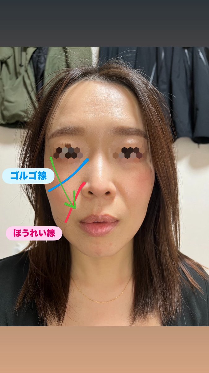 babu_yanagawa's tweet photo. これは、頬肉の下垂(ナゾラビアルファットの下垂)によるもの☝️

これに伴って、ゴルゴ線も出てきはじめるはず。

中顔面の脂肪は、年齢と共に重量で下に引っ張られ、下垂する。
そして、ほうれい線上に溜まることで、ほうれい線を作る。

さらに、これによって中顔面の"重心"が下がり、"老け見え"の原因になる。

治療法は至ってシンプル💡

"垂れ下がった脂肪を無くす"

「バーティカルリフト」など、糸リフトの選択肢を勧めるドクターがまだいるのか分からないけど🥲、多くの人が感じているように、効果は数ヶ月。

2.3ヶ月の短期間の改善を期待するならいいけど、長期的な根本治療にはならない。

また、
「持ち上げて固定する」という選択肢もあるが、脂肪が多い状態、つまり"重い状態"で引き上げて固定するのはほぼ不可能。

普通に考えて例えば１０キロのオモリを引き上げてキープし続けるは無理なのと同じ😭

ポイントは"軽くしてから"引き上げること。

根本治療は、

"ミッドチークバックリフト®︎"

ナゾラビアルファットを除去し、その際の癒着を利用して上に持ち上げてくっつけるもの。

ほうれい線治療＝ミッドチークバックリフト

と言っているのではなくて、このタイプの脂肪がある程度多くて下垂しているパターンの人には、本当にピッタリ💡

悩んでいる人は是非参考にしてみて✨

👇ミッドチークバックリフト®︎のビフォアフ