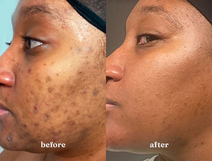 noradiskin's tweet image. Don't say anything, just repost.

#beforeandafter #skintransformation #acneproneskin