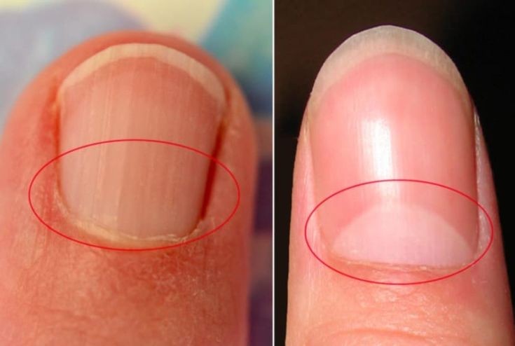 Apa kamu masih punya lunula? 

Apa yang terjadi pada kuku sebenarnya adalah tanda/sirine agar kita lebih memperhatikan kesehatan kita. 

Ketiadaan Lunula/ lingkaran setengah bulan, atau ada lunula tapi mengecil, hal itu menandakan kondisi kurang gizi, anemia, stress tinggi atau