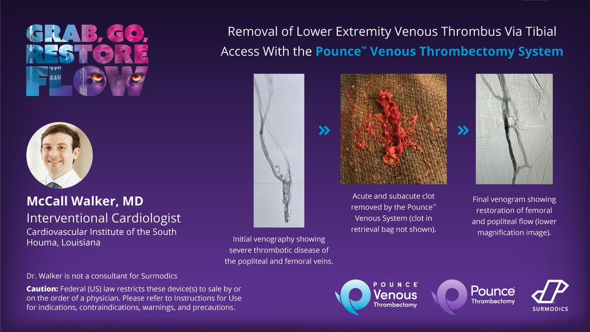 Surmodics's tweet image. Dr. McCall Walker used the Pounce™ Venous Thrombectomy System via tibial access to remove a substantial amount of acute and subacute clot with only 15 minutes of #thrombectomy time. Read the full case: @EVToday: na2.hubs.ly/H04LsJp0 #CLOTCHA Rx only.