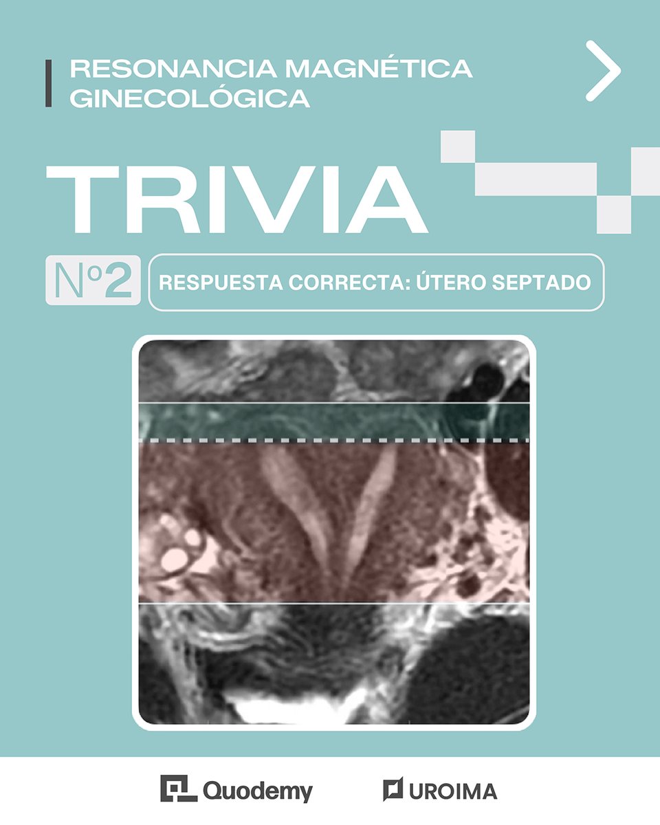 _uroima's tweet photo. 📣Comunicamos la respuesta correcta de nuestra reciente trivia. Click aquí: https://t.co/mdZPUUNSSt

👨🏻‍⚕️ Respuesta elaborada y diseñada por el Dr. Edgar Jacquez, de México

¡Muchas gracias a todos por participar! 👏 https://t.co/IIafYTrZHH