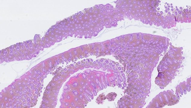 katcollmd's tweet photo. #GISlideBar melanosis coli: a pigment footprint from apoptosis in the lamina propria 👣 not linked to malignancy, and oddly great at highlighting tiny polyps 👀 #gipath #pathtwitter #pathoutpic 

🔗 https://t.co/pLj8XDV2JN https://t.co/Fof3MXXIZF