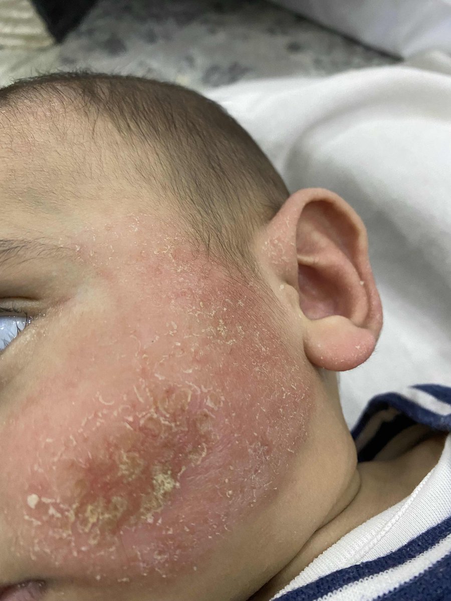 FadiQGaza's tweet photo. My brother is in so much pain…💔
His face is terribly inflamed, and it's getting worse every day.

We're unable to help him properly… Any small support can ease his pain 🤍
Donation link in bio https://t.co/Bm1XAi3SP0