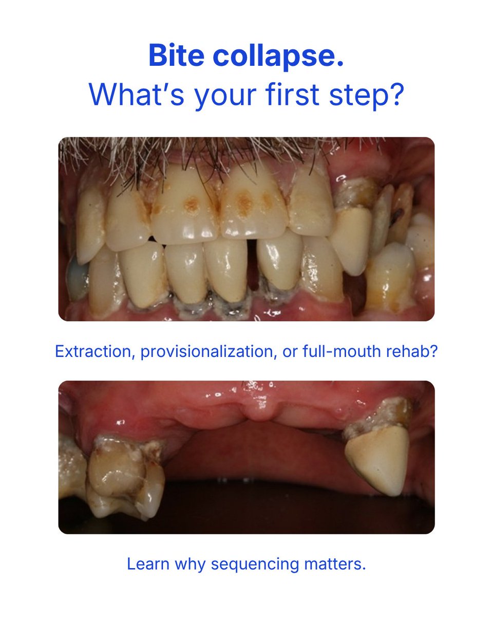 SpearEducation's tweet photo. Complex cases don’t happen overnight.

Bite collapse. Super-eruption. Severe wear.
Treating all at once can fail.

Phased restorative dentistry helps you:
✅ Test vertical dimension
✅ Provisionalize first
✅ Reduce risk &amp; improve outcomes

Read more: https://t.co/7uX4vv6GMS https://t.co/KmM1eZYAVE