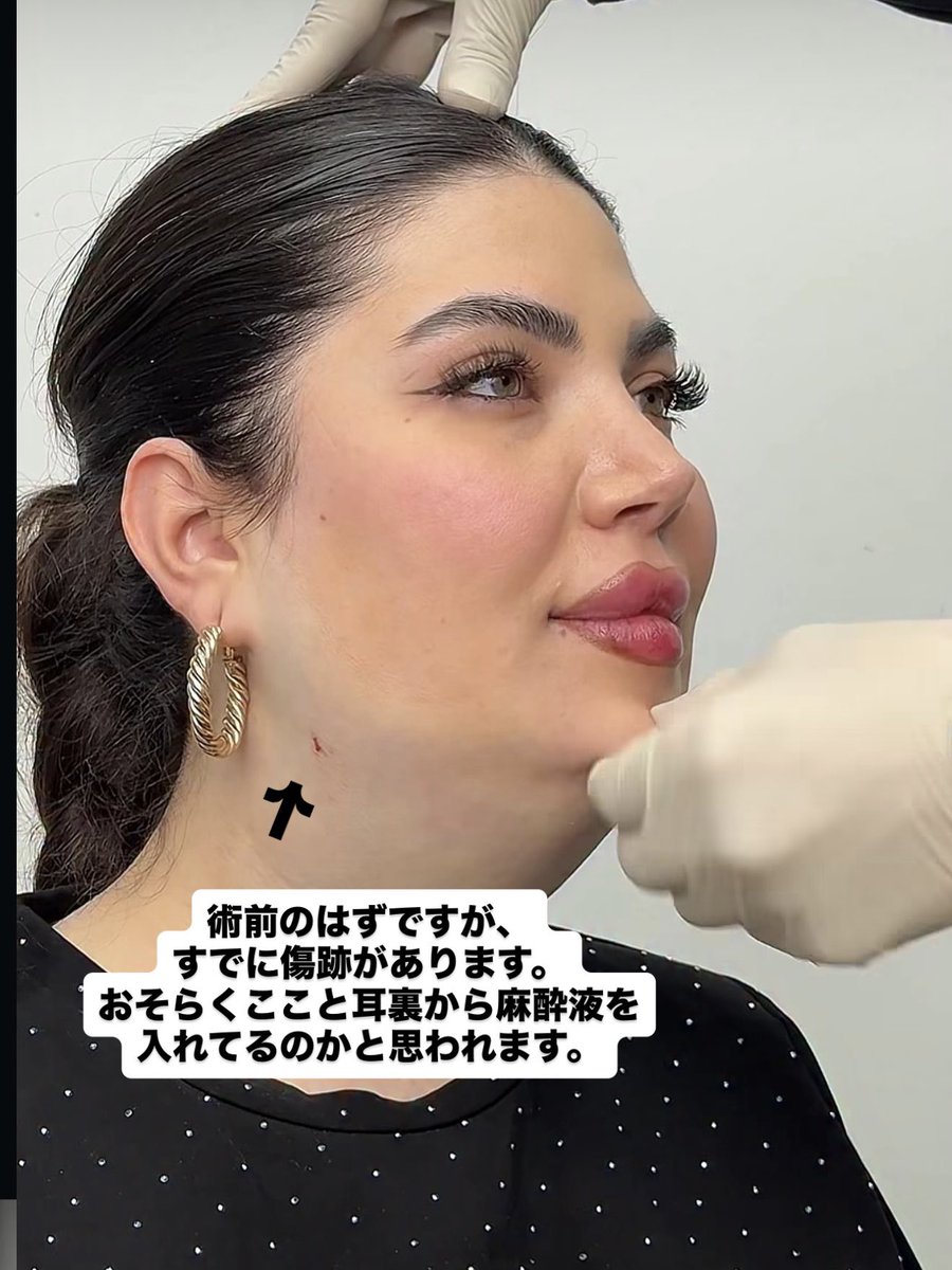 dr_tomo___'s tweet photo. 【“1時間で激変”の正体】

結論👇
👉麻酔液です

⸻

脂肪吸引では
チュメセント麻酔という液体を入れる💉

これで👇
・一時的にパンパンに膨らむ
・皮膚が白くなる

⸻

その状態から吸うと👇

👉脂肪＋麻酔液が一気に減る
＝めちゃくちゃ変わったように見える😳

⸻

つまり👇

動画の変化
＝脂肪だけじゃない

👉“麻酔液の分”も含まれてる

⸻

さらに👇
✔ 術前なのに傷がある
✔ 顎下だけ白い

→すでに麻酔入ってる可能性高い

⸻

❗脂肪吸引自体はちゃんと効果あります
でも👇

👉SNSの激変＝そのまま結果とは限らない

⚠️見分けるのは難しい場合もありますが、術前の顎下があまりにもタプタプすぎる場合は注意しても良さそうです⚠️