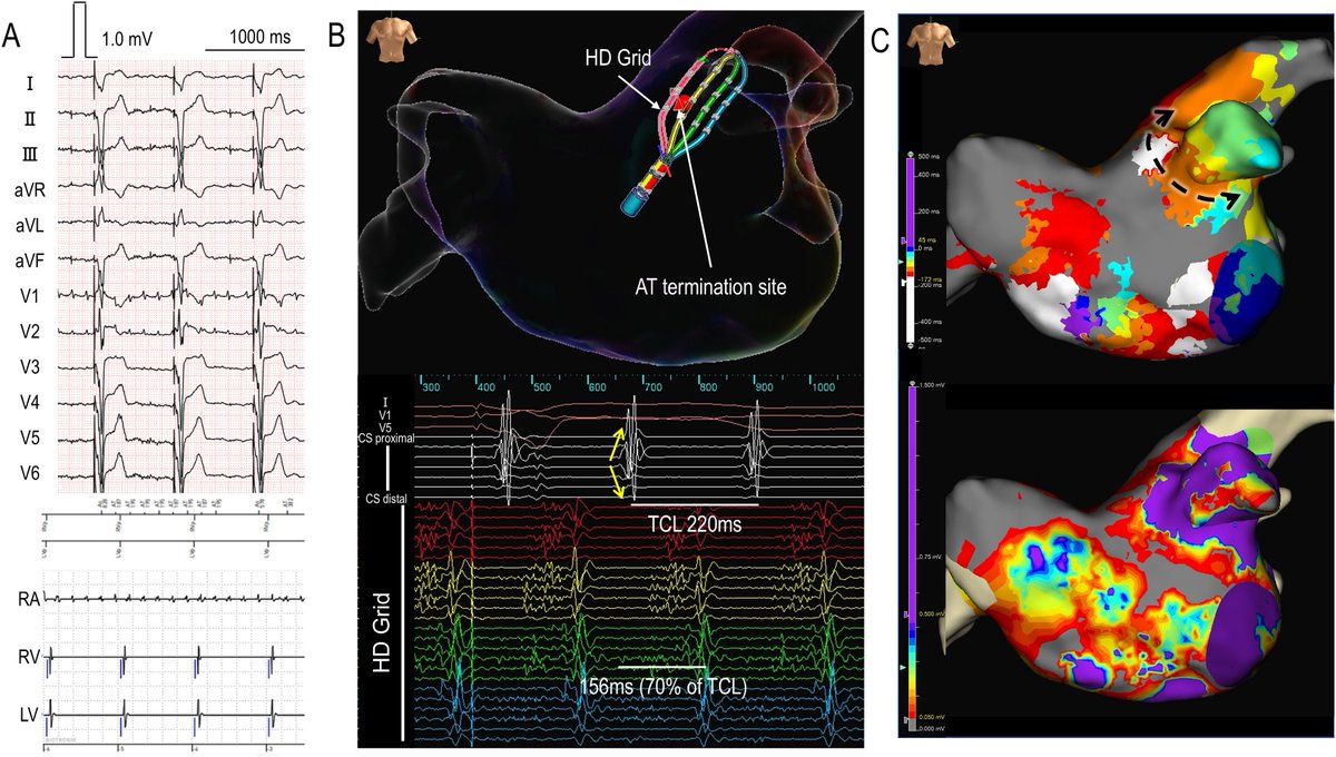 Heart Rhythm Case Reports tweet media
