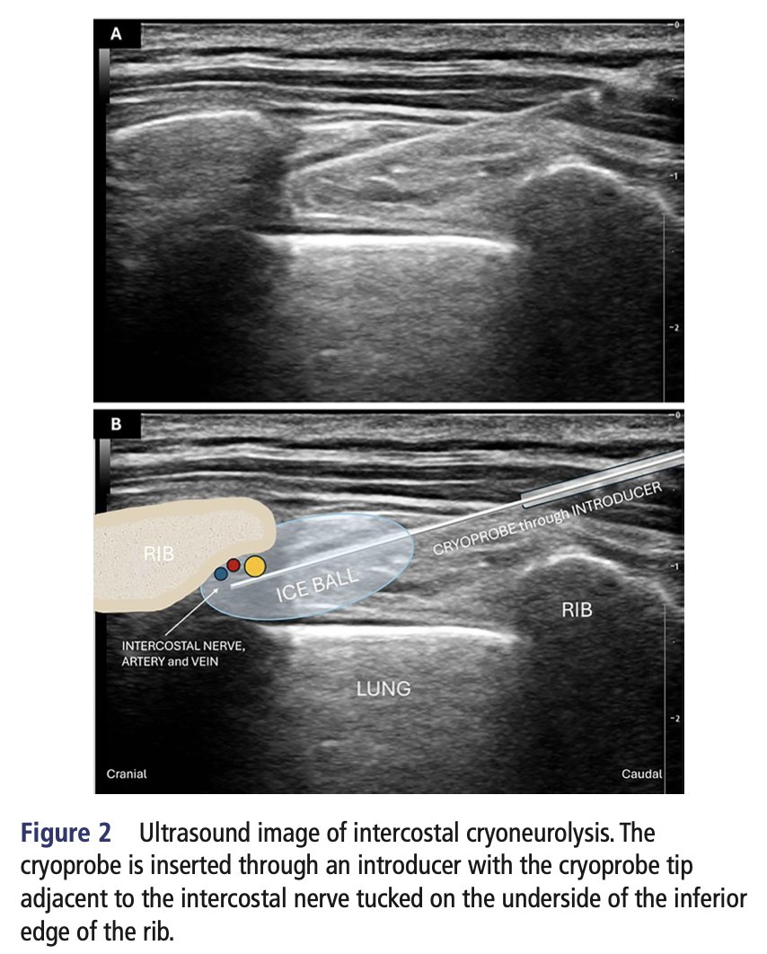 CAS_RegAnes's tweet photo. 🔥Canadian Reg Anes Research:
https://t.co/UcRvlEq5CD

Jew et al. of St. Paul's Hospital, Vancouver discuss USG cryoneurolysis of intercostal nerves for high-risk traumatic rib fracture patients.

@ubcanesthesia https://t.co/mGk2XNWA4m