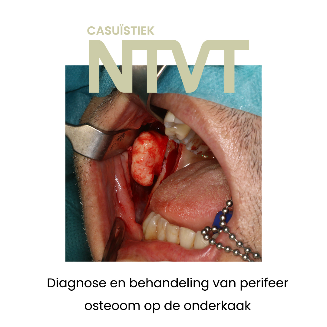 Een osteoom is een benigne, langzaam groeiende tumor uitgaande van het bot en niet altijd onschuldig. Waar moet je aan denken bij de diagnose en behandeling van deze aandoening? 

Lees over deze casus in de april-editie: doi.org/10.5177/ntvt.2…