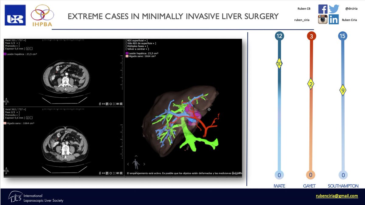 drciria's tweet image. Ready 4tmrrw💪🏻
@saludand @HUReinaSofia @aechbp  @juliomayol @aecirujanos @quironsalud #SoMe4Surgery #SoMe4HPB @santiazagra @IHPBA @smoralesconde @asacirujanos @JHawksworthMD @Giammatwit @LopezBenS @Abuhilal9Abu @cdopazo1 @EAHPBA @Serrablohpb 
@cordobabn @hospital_hvn @CEIHPBA
