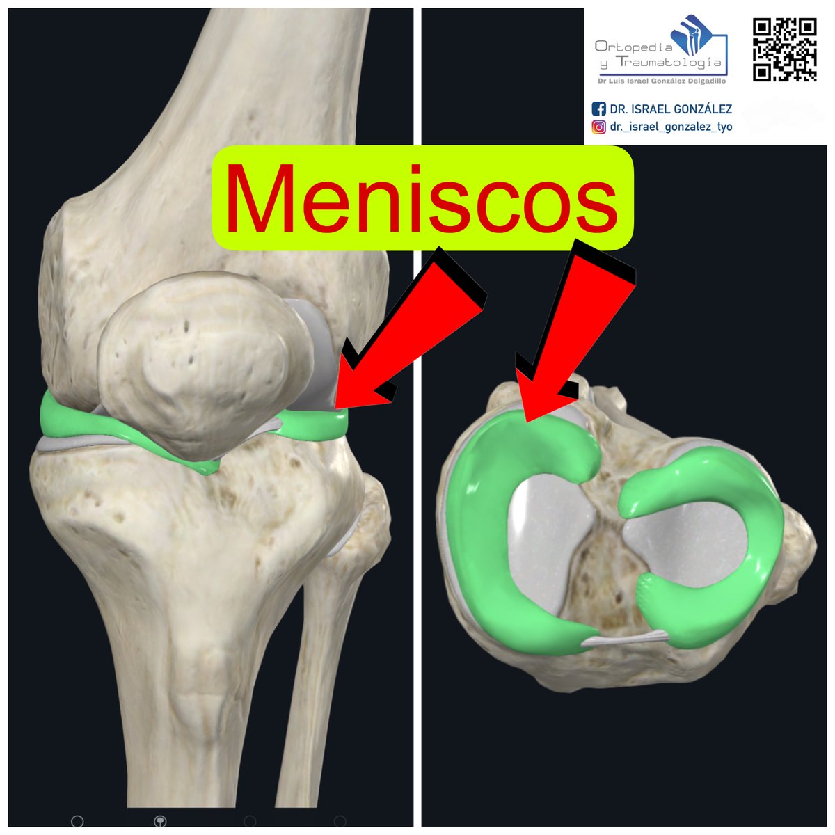 mdgonzaleztyo's tweet image. ¿Lesión de menisco? No siempre hace falta operar. Aprende cuándo se recomienda cirugía y cuándo apostar por rehabilitación. Lee más: wix.to/UubW7CR

#menisco #rodilla #traumatologia #ortopedia #artroscopia #drisraelgonzalez