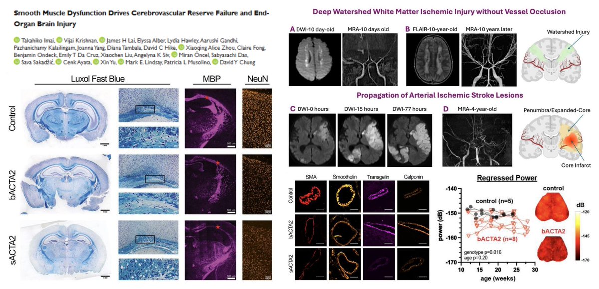 HaoYin20's tweet photo. #MultisystemicSmoothMuscleDysfunctionSyndrome #MSMDS

Myh11+ Smooth Muscle Cell Acta2 R179H transgenic🐭(?Age?)
⏬Cerebral artery curviness, inner diameter
⏬Cerebral arterial contractile proteins
⏫Cerebrovascular SMC proliferation in culture
⏬Spontaneous cerebral blood volume fluctuation (BOLD)
⏬Vasoresponses to both SNP & PE
⏫Anesthetized BP (likely as compensation)
⏬Cerebral blood flow & ⏫Survival upon unilateral common carotid occlusion
⏬White matter myelination
⏬Cortical neurons
⏫Neurobehavioral anomalies

@imai_takahiko @chungmdphd bioRxiv 2026
https://t.co/l5ZU7zDn1Y