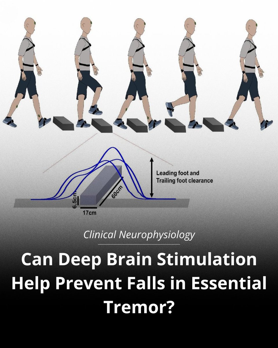 FixelInstitute's tweet photo. A new study by UF researchers explores how deep brain stimulation (DBS) may improve walking and reduce fall risk in people with essential tremor.
Full study: https://t.co/b02i7z5e8h
#DeepBrainStimulation #EssentialTremor #FallPrevention https://t.co/6JXeXOdCom