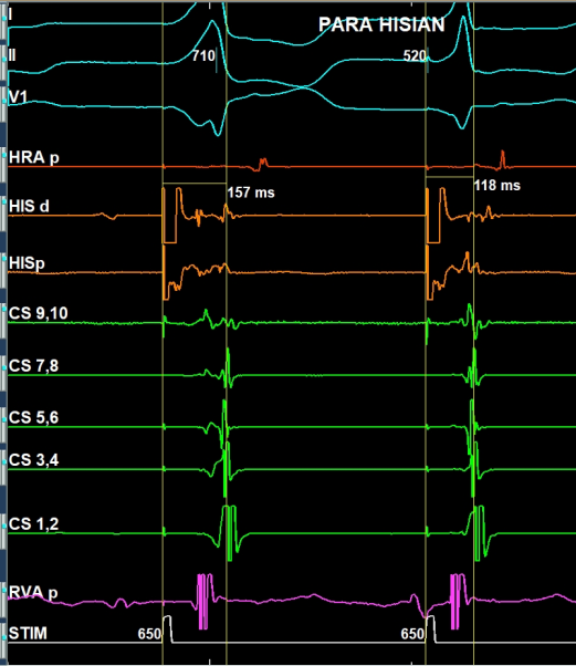 syamkumarmd's tweet photo. A tracing for EP fellows and EGM enthusiasts. What is the interpretation of this PHP? https://t.co/zoeA0izdWq