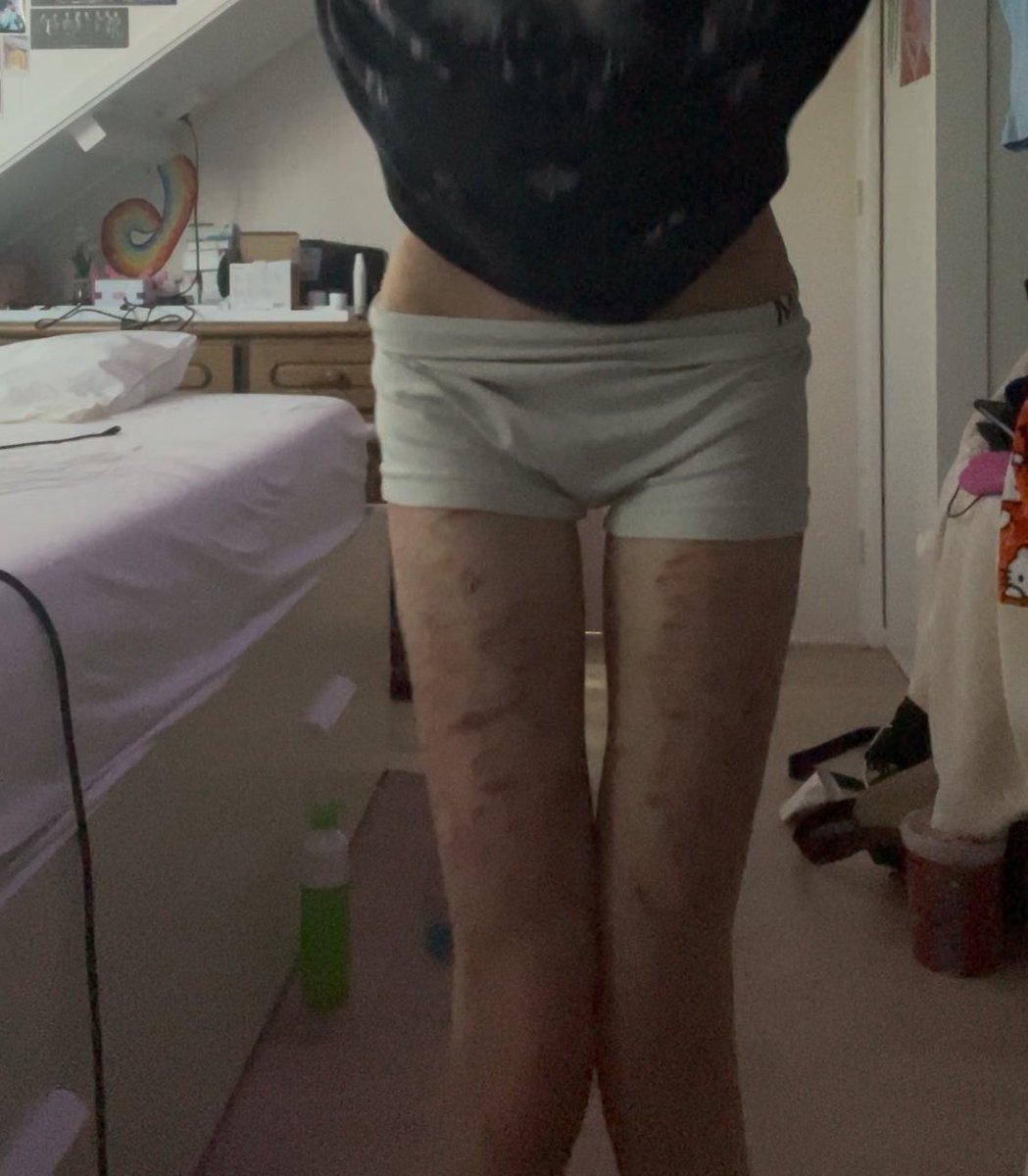 Hemophobia127's tweet image. Bodychecks from like idk today or yesterday

Am I delusional or do my legs look very similar to hers in this fancam??
(I’m not sure bc I can’t see myself normally due to the body dysmorphia, mine goes both ways😬)
Couldn’t find more similar poses sorry💔
#shedtwt