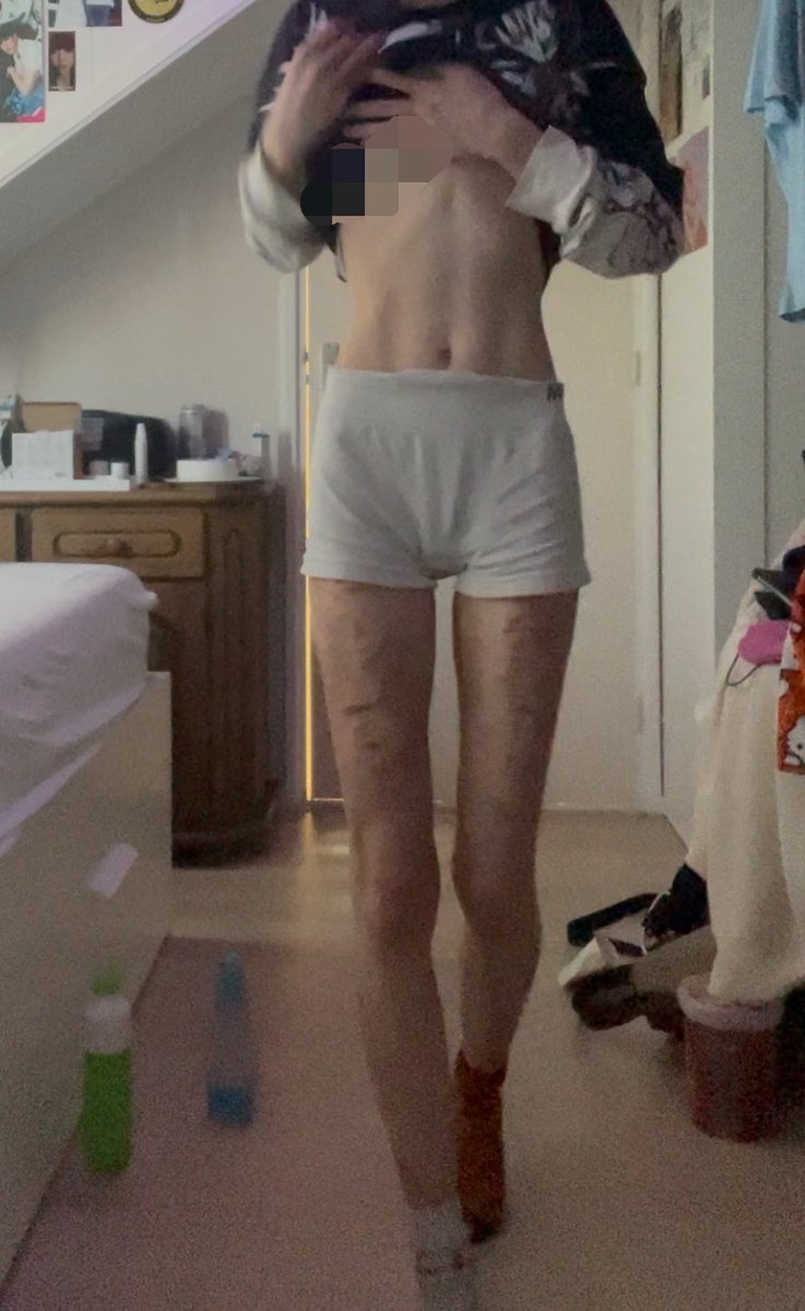 Hemophobia127's tweet image. Bodychecks from like idk today or yesterday

Am I delusional or do my legs look very similar to hers in this fancam??
(I’m not sure bc I can’t see myself normally due to the body dysmorphia, mine goes both ways😬)
Couldn’t find more similar poses sorry💔
#shedtwt