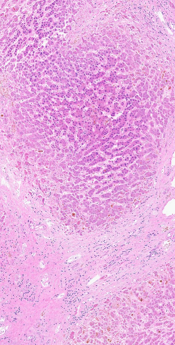 ZemplenPataki's tweet photo. Organ? Diagnosis?  🔎

Poll below 🗳️👇

#PathPuzzle 🕵️‍♂️
@UMichPath #Pathology #PathX #PathTwitter https://t.co/zHsNf6BgfR