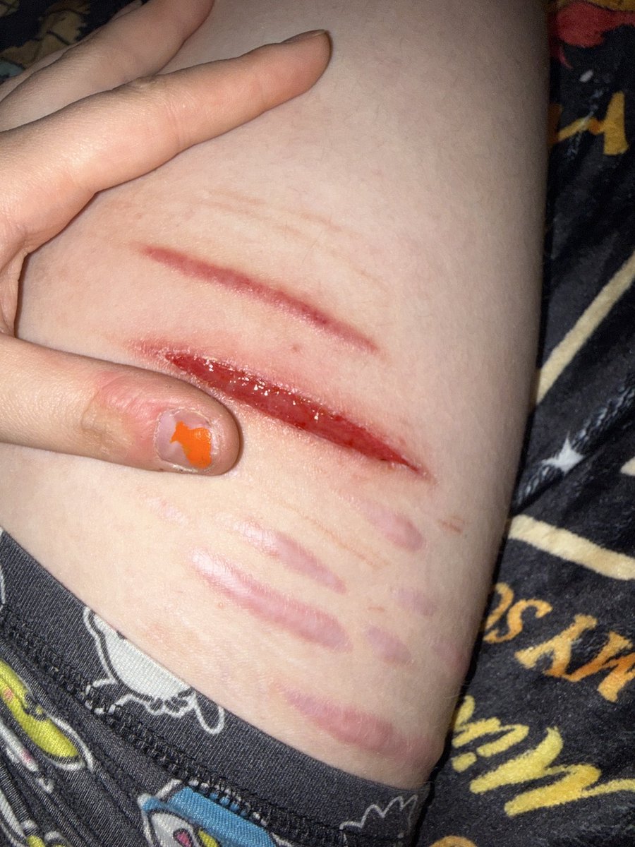 Guys holy shit the shrinkage is HORRIBLE it’s killing me 
No stitches, no butterfly bandages, just dry healing. What.