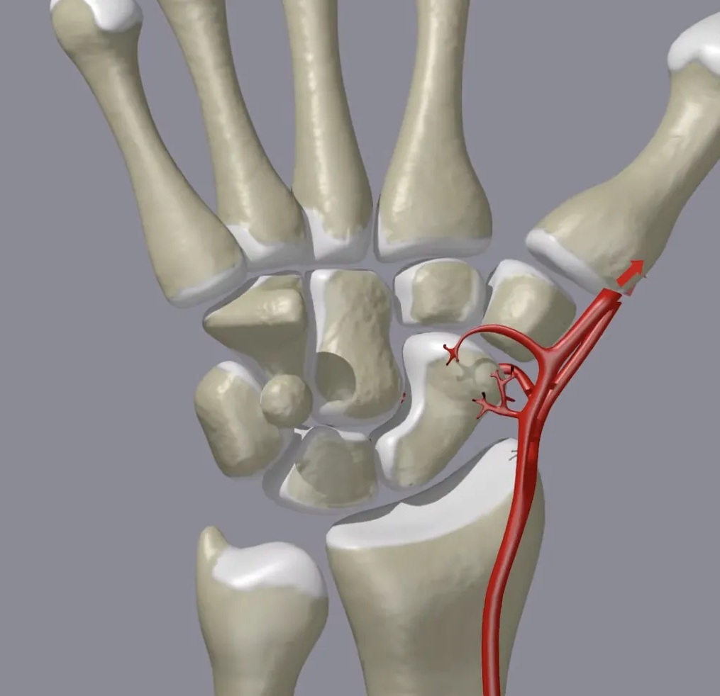 MedEd_Cases's tweet image. Fall on an outstretched hand with wrist pain… 👀
This is one of the most commonly missed fractures.
You shouldn’t miss it on this xray.

Can you name this fracture?

Read: wikism.org/Scaphoid_Fract…

#orthopedics #radiology #xray #mededucation #sportsmedicine #emergencymedicine