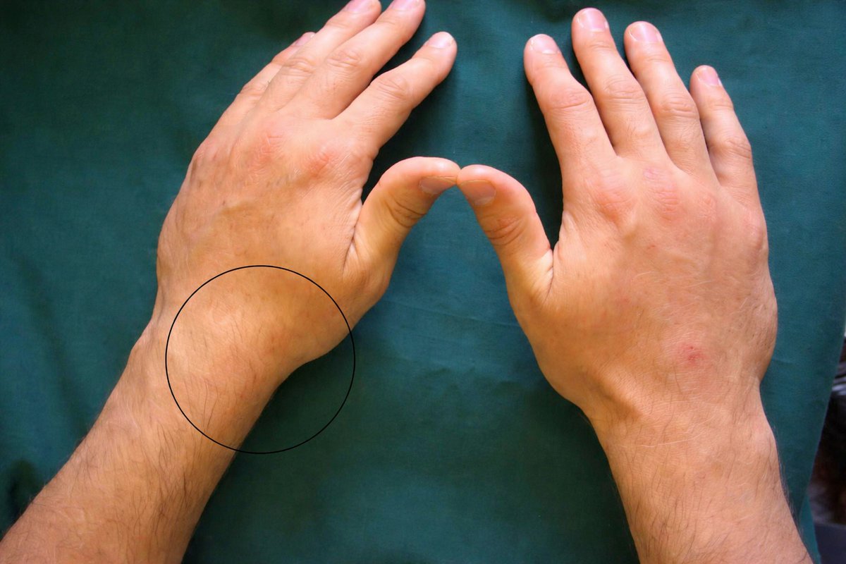 MedEd_Cases's tweet image. Fall on an outstretched hand with wrist pain… 👀
This is one of the most commonly missed fractures.
You shouldn’t miss it on this xray.

Can you name this fracture?

Read: wikism.org/Scaphoid_Fract…

#orthopedics #radiology #xray #mededucation #sportsmedicine #emergencymedicine