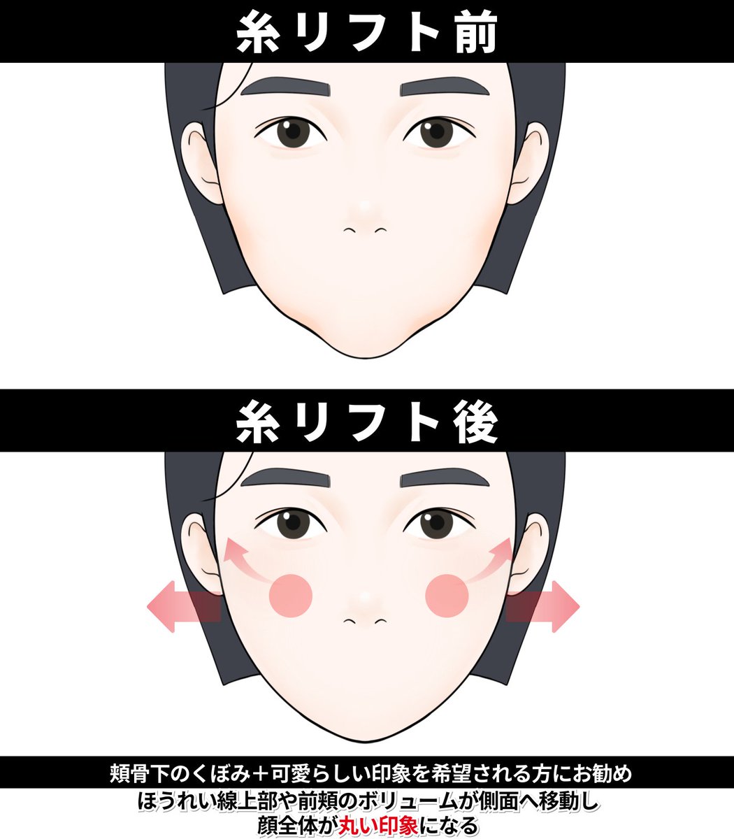 【切開リフト・脂肪吸引専門】 スターライン美容外科 tweet media