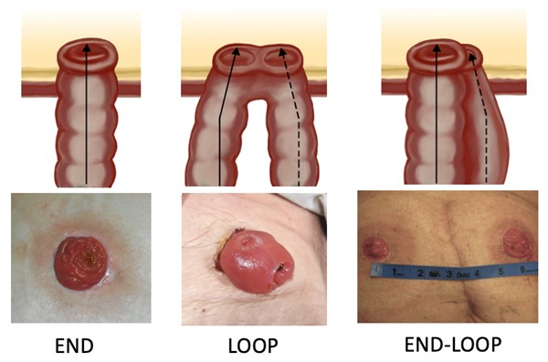 Types of stoma construction