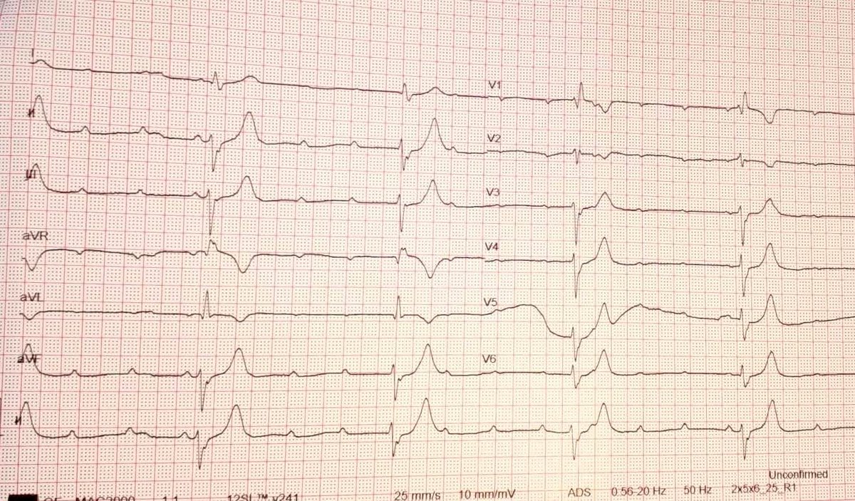 albertoortegana's tweet image. What your diagnosis? 
A. 2nd degree AV block. 
B. Complete heart block 
C. Sinus Bradycardia 
D. Atrial Fibrillation
#MedTwitter #FOAMed #MedX