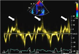 RitikaTuliMD's tweet photo. #CardioNugget 

Pickelhaube sign = sharp, high-velocity systolic spike (>16 cm/s) on tissue Doppler at the lateral mitral annulus 🪖

Seen in mitral valve prolapse → reflects sudden systolic annular recoil

⚠️ Red flag for arrhythmic MVP & ↑ risk of ventricular arrhythmias/SCD

#EchoBoards #Cardiology #MedEd