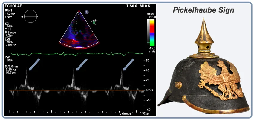 RitikaTuliMD's tweet photo. #CardioNugget 

Pickelhaube sign = sharp, high-velocity systolic spike (>16 cm/s) on tissue Doppler at the lateral mitral annulus 🪖

Seen in mitral valve prolapse → reflects sudden systolic annular recoil

⚠️ Red flag for arrhythmic MVP & ↑ risk of ventricular arrhythmias/SCD

#EchoBoards #Cardiology #MedEd