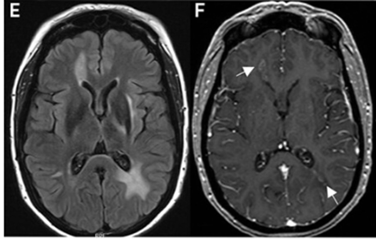 Brandon_Beaber's tweet photo. 44-year-old woman with vision loss/confusion. MRI brain shows enhancing periventricular lesions.  Multiple Sclerosis?  No!  Diagnosis?  Prepare to fail miserably. https://t.co/sskWXmfSLP