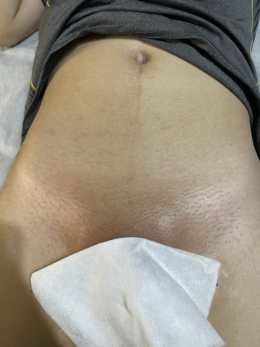 Jsys2h's tweet photo. 私密處除毛

照片均經過當事人��意之拍攝並分享
未滿🔞歲禁止觀看

🖤男性熱蠟除毛師
📍大里| 霧峰 | 太平
採預約制1對1｜無需女性陪伴｜歡迎私訊預約

#台中 #熱蠟除毛 #大一 #學生 #男士除毛 
#大學生 #私密處 https://t.co/TiTd6FtDLE
