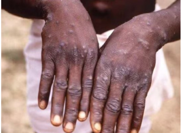 Health officials urge caution as monkeypox spreads through close contact. Protecting vulnerable groups, especially newborns, must be a priority as Sindh strengthens containment efforts. #HealthSafety #DiseasePrevention #Sindh