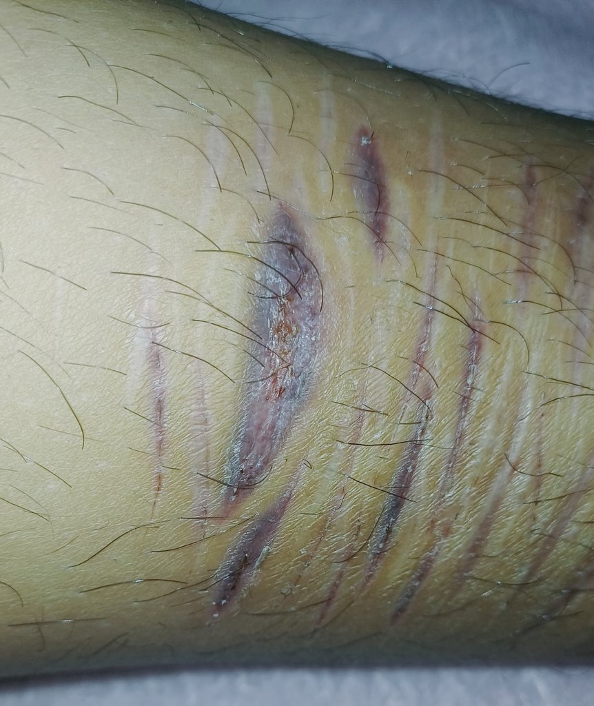 DamoroIsDead's tweet photo. It took a month ti heal. I wanna shave my legs but it's too early still #shtwt #slittwt #scarspo https://t.co/PJQu09JMfR