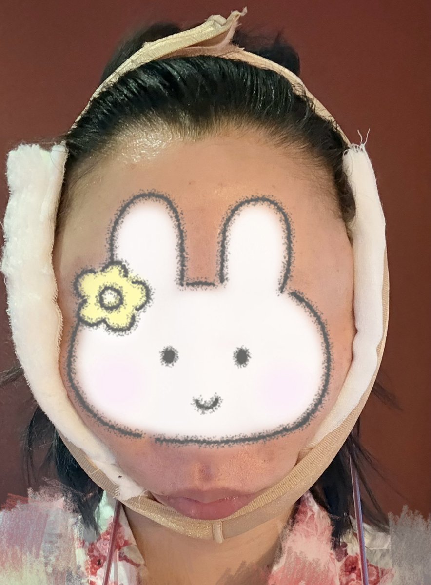 panini8825's tweet photo. だいぶ昔から通い詰めてるエートップ🅰️でペリカン手術しようとしたんだけど、私のは皮膚のたるみらしく😢全切開リフトしたよ
過去１長い時間のオペでとりあえず尻が痛い
※ドレーンついてます
※顔はリジュランも打ってもらった

←当日
　　　　　1日目→ https://t.co/UURuexWaci