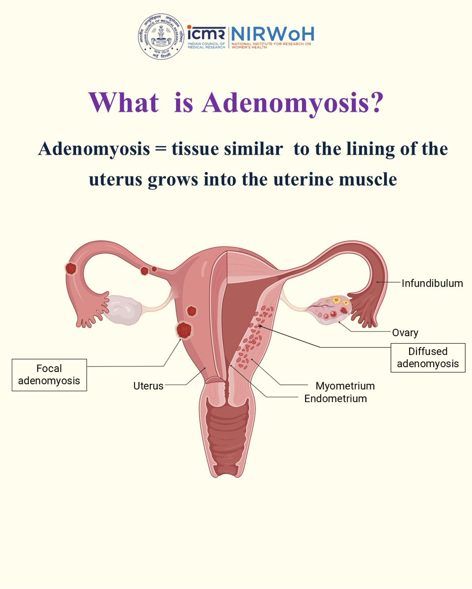 icmrnirwoh's tweet photo. Heavy periods are NOT normal. It could be #Adenomyosis!
April is #AdenomyosisAwarenessMonth
#WomensHealth #Endometriosis #PublicHealthIndia https://t.co/NiejATaWDU