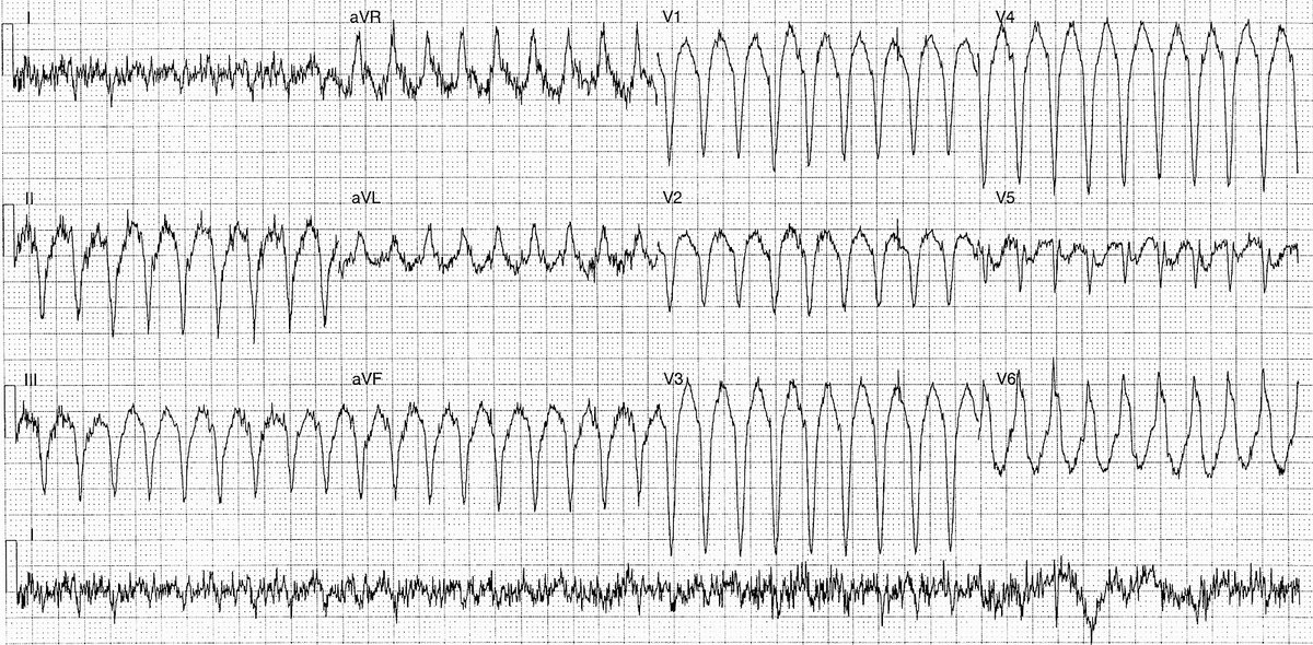 ManualOMedicine's tweet image. A 76 y/o female with palpitations and dyspnea.
- What’s the rhythm ?

#medtwitter #foamed #ecg #cardioed