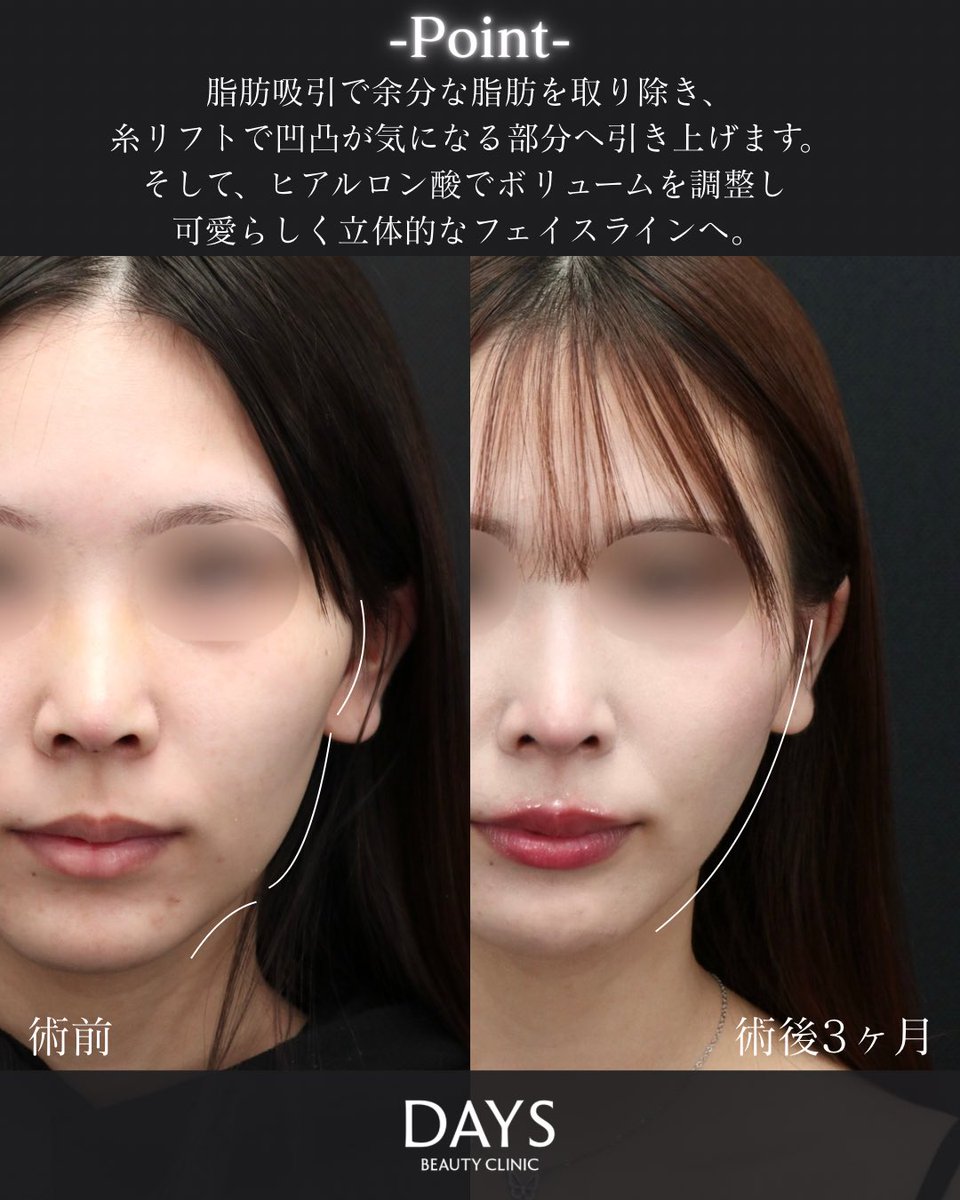 小顔整形 山野祐 tweet media
