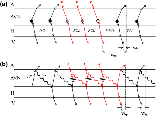 KostekMilan's tweet photo. 🔴The ventriculoatrial relationship after atrial overdrive pacing can help differentiate atrioventricular nodal reentrant tachycardia from junctional tachycardia 🔴
* not free * 🧵 🧵 🧵 https://t.co/ix3G4E1aSW