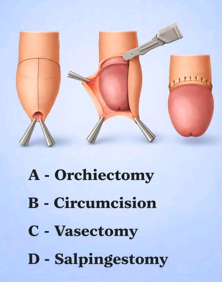 TwizerimanaAbu1's tweet image. Only 1% will get this right… what procedure is this? 🤔
#MedTwitter #DidYouKnow