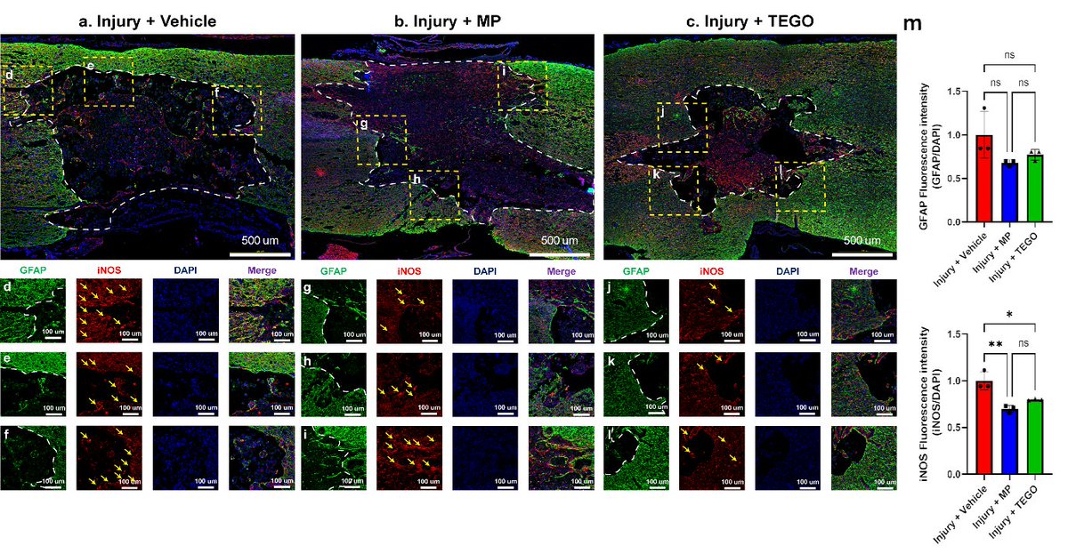 Discovery_Med's tweet photo. 📢 Discovery Medicine: Today's Featured Article🌟
💊Anti-Inflammatory Therapeutic Effect of Tegoprazan in Spinal Cord-Injured Rats
👉Read the full article here: https://t.co/qJMldcbNzv
#Tegoprazan #AntiInflammatory #SpinalCordInjury
#Neuroinflammation #RodentModel #Rats https://t.co/hQDWJ5ZDvh