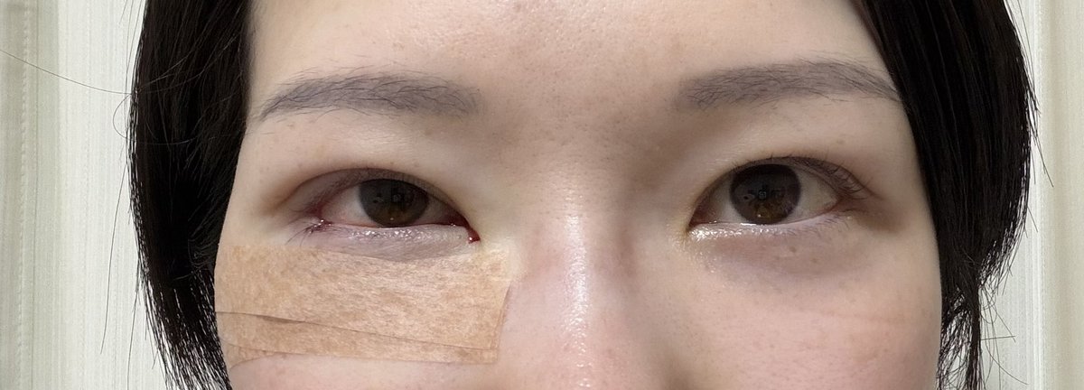ranDTkiroku's tweet photo. 本日、裏ハムラの微修正やってもらいました🏥笑うと右側(写真だと反転するので左側)だけ膨らみが少し残っているので、修正できるか相談してみたら、可能とのことでやってきました✌️笑わなければ分からない程度ではありますが… https://t.co/do236RflFv