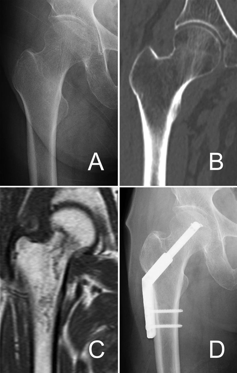 MedEd_Cases's tweet image. The patellar pubic percussion test evaluates for occult hip fractures. The bell of a stethoscope is placed over the pubic symphysis, typically held in position by the patient. With the legs in neutral and knees extended, the examiner percusses each patella, comparing the pitch