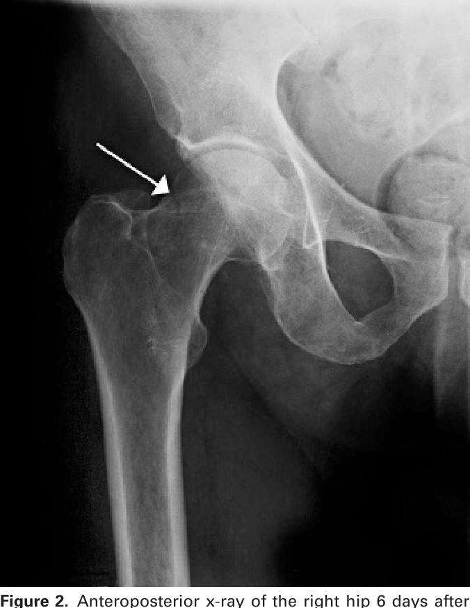 MedEd_Cases's tweet image. The patellar pubic percussion test evaluates for occult hip fractures. The bell of a stethoscope is placed over the pubic symphysis, typically held in position by the patient. With the legs in neutral and knees extended, the examiner percusses each patella, comparing the pitch