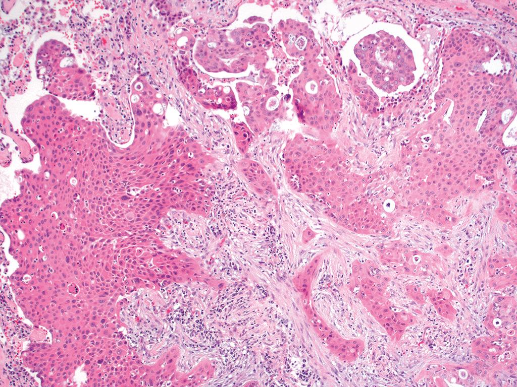 DrCycloPath's tweet image. #PathQuiz 🔬🫁 #PulmonaryPath

A) Squamous
B) Adeno
C) I dunno (something else)
D) Both (adenosquamous)

#Pathology #SurgPath #PulmPath