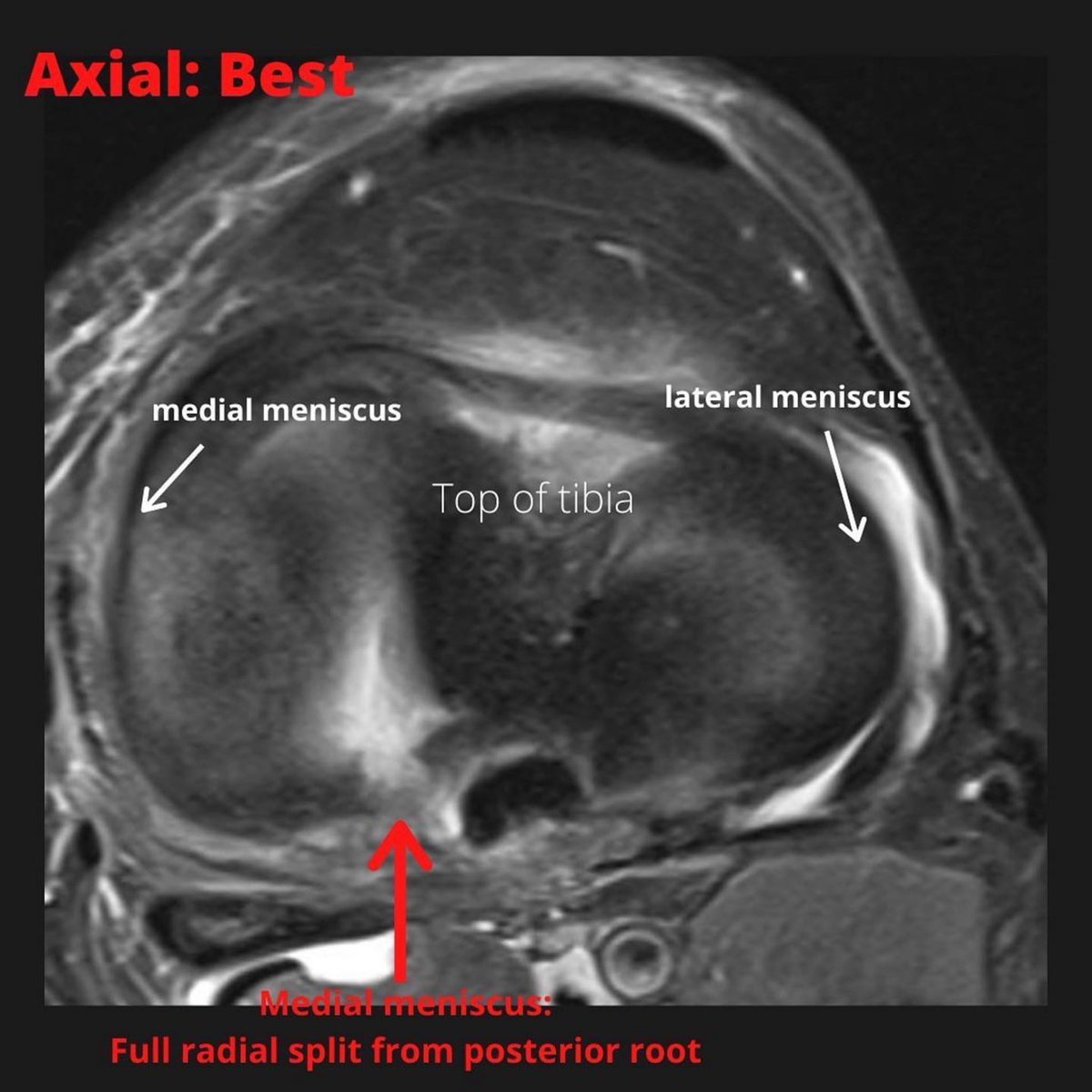 PhysioOsteoGram's tweet photo. What are meniscus roots?

They attach the meniscus to the top of the tibia bone, holding the meniscus in place and provide stability.

❇️ What happens with a root tear? 
 
A complete root tear is equivalent to having the whole meniscus… https://t.co/9lGiEZo57x https://t.co/LlNBYBdAvN